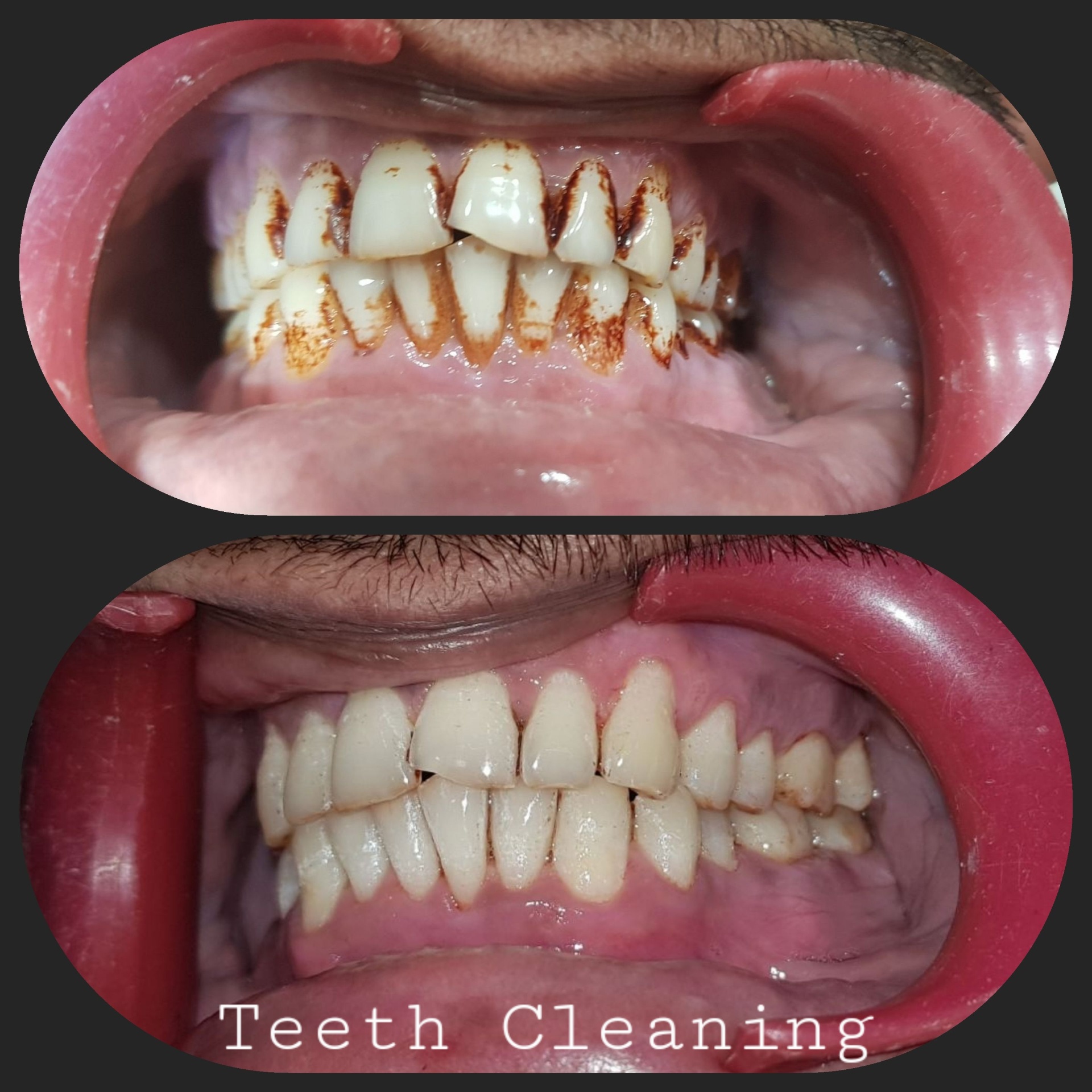 Teeth Whitening