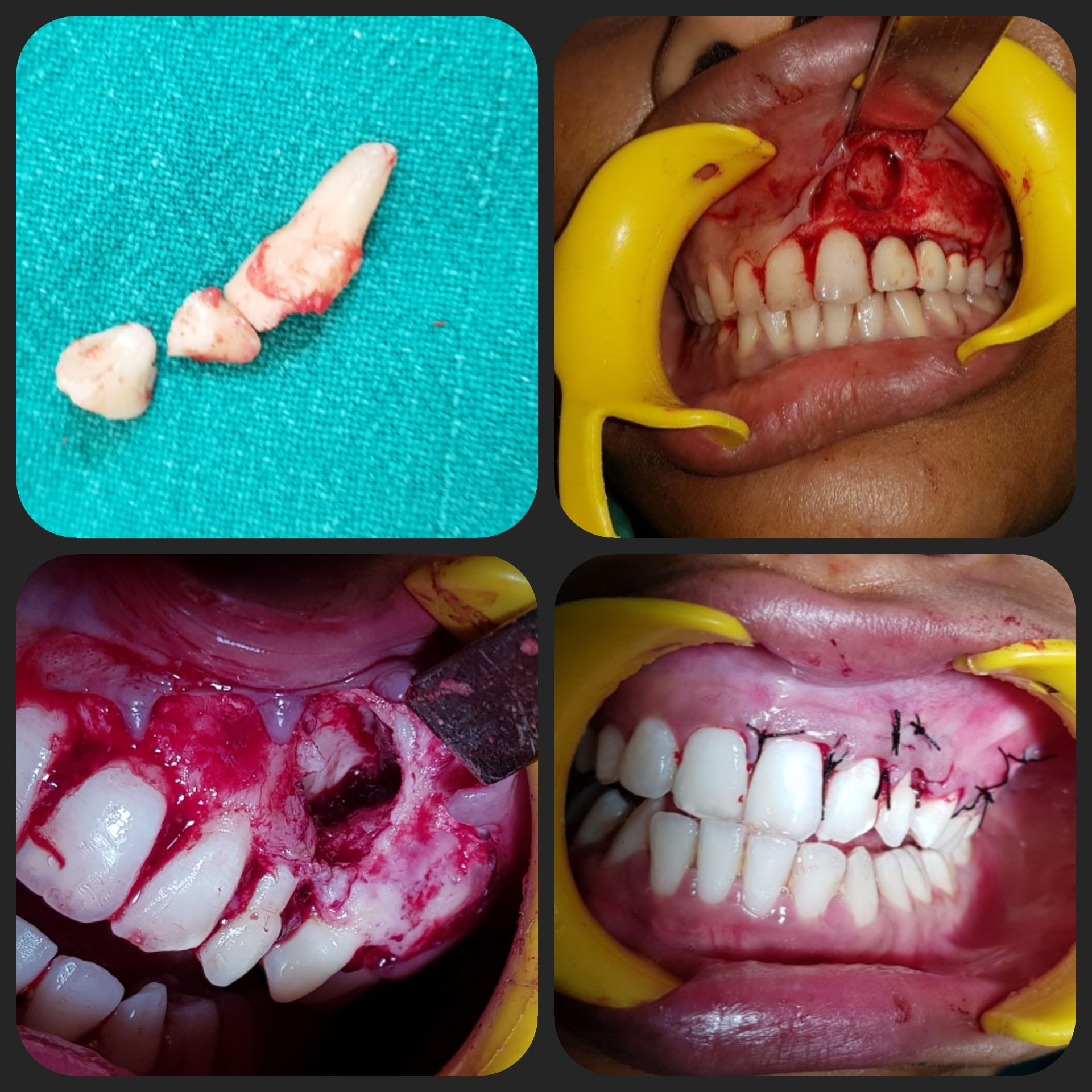 Impacted Tooth 4