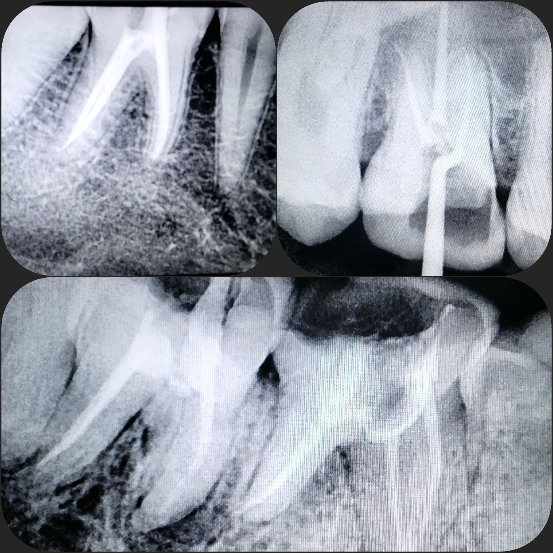 Root Canal Treatment