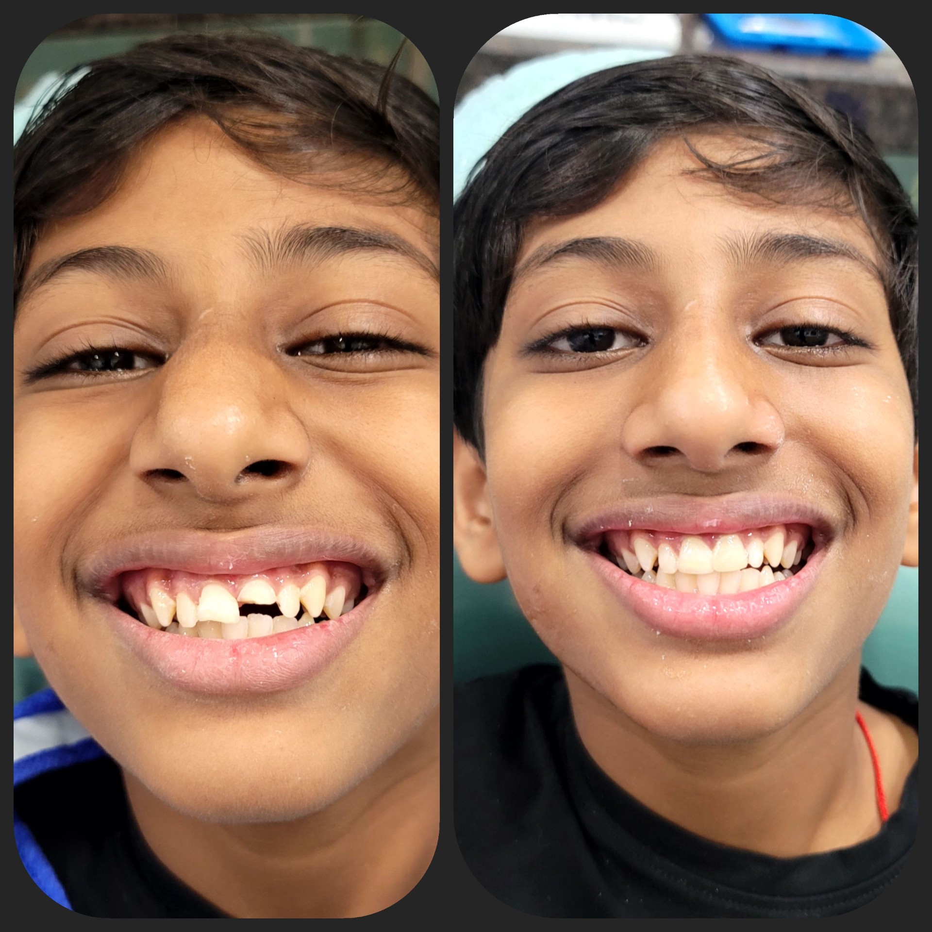 Smile makeover before and after result