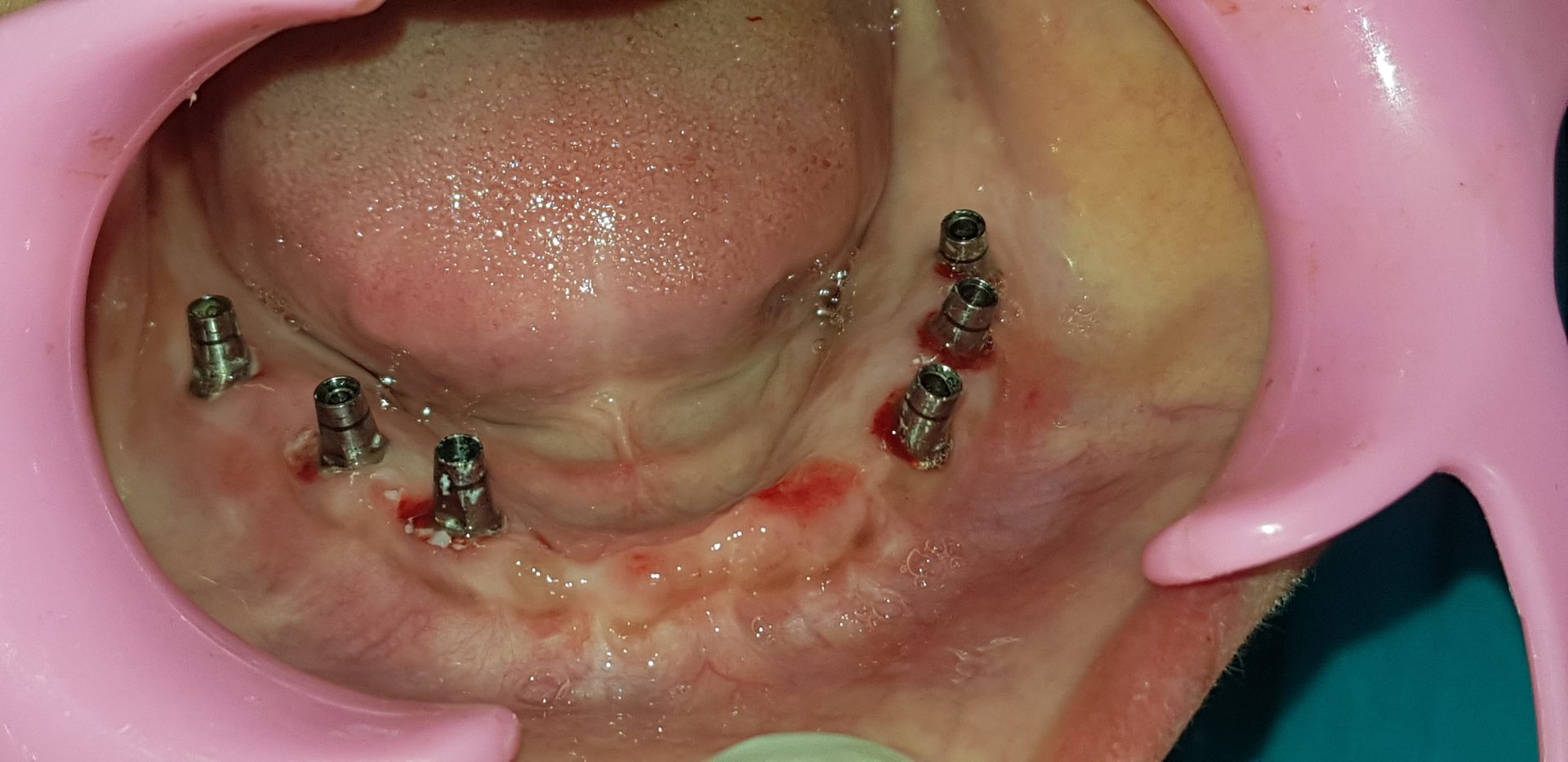 Dental implant model and tools