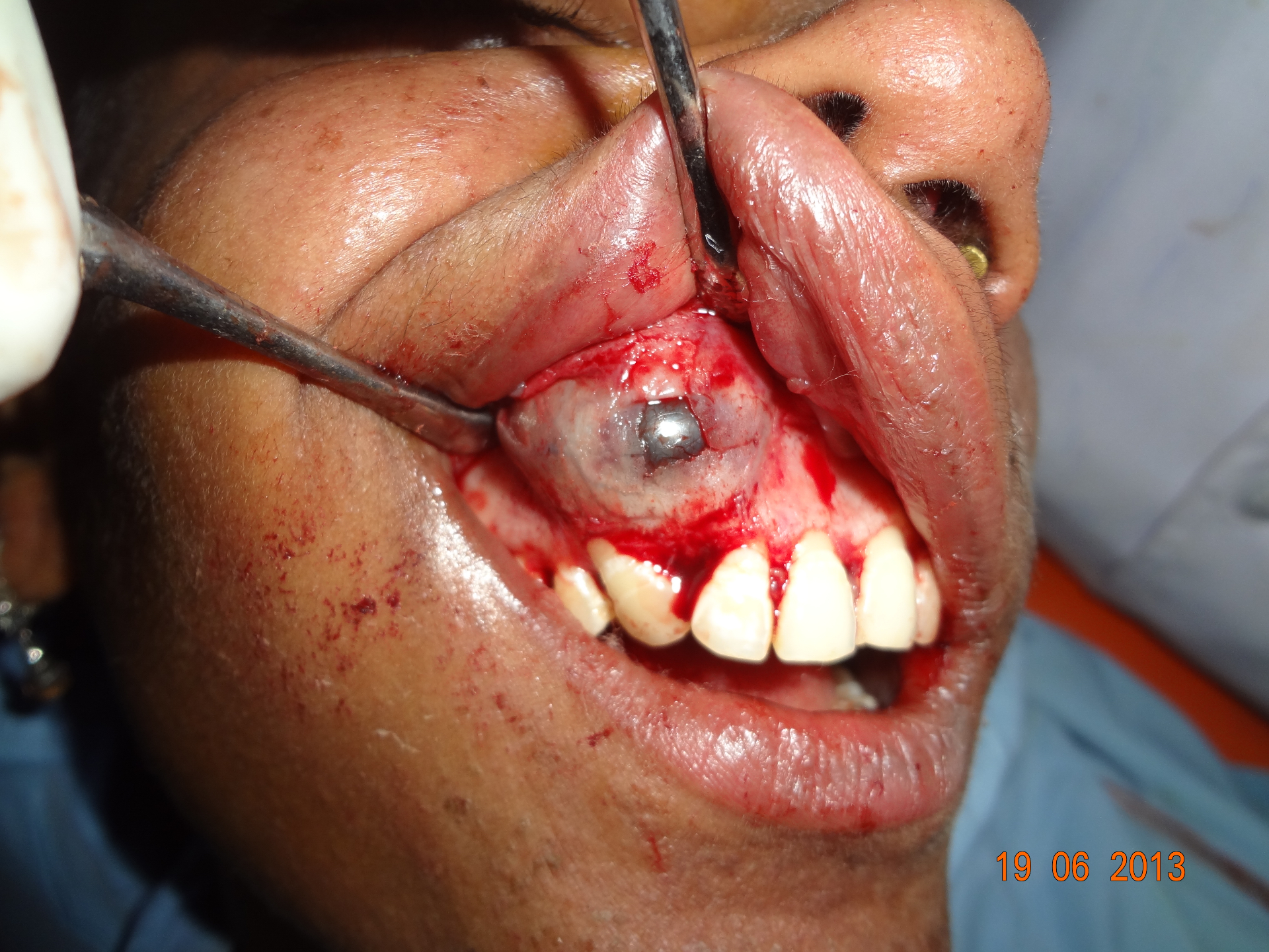 Surgical Case 4