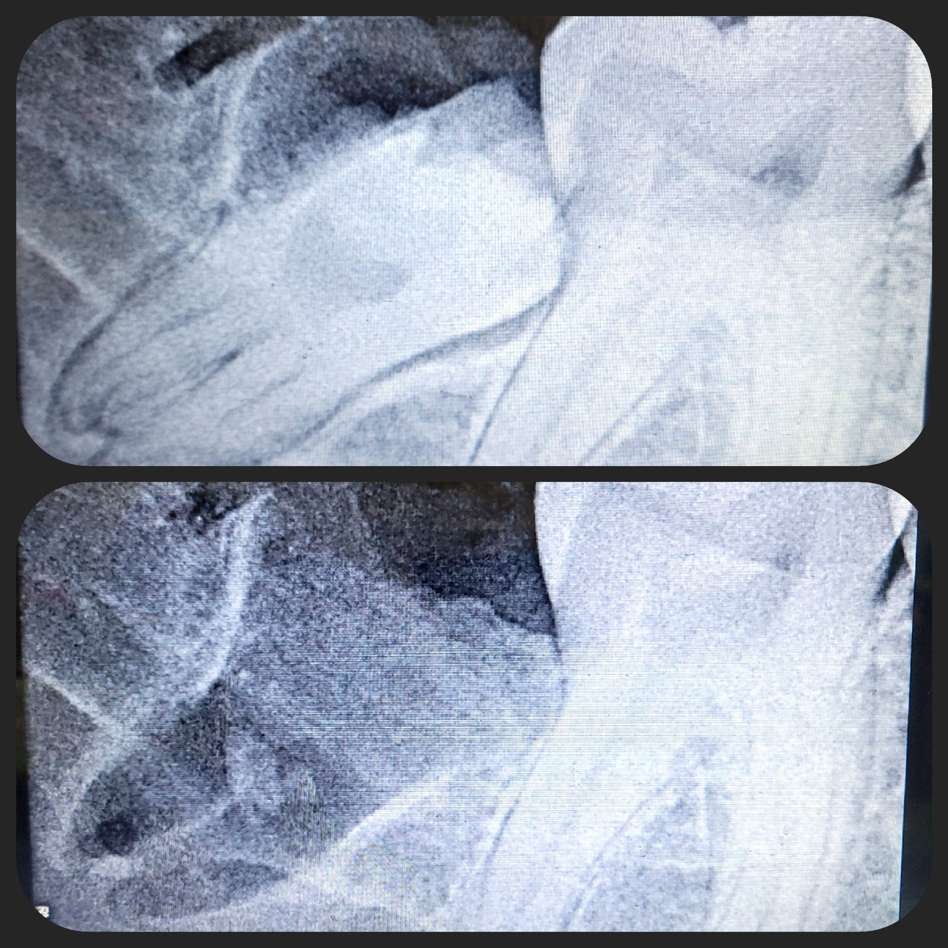 Impacted Tooth 1