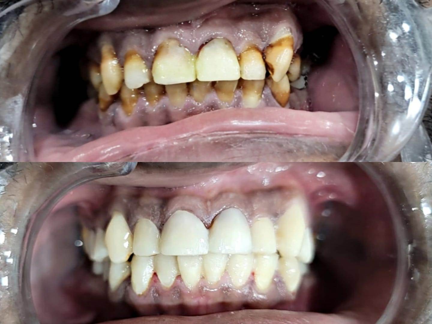 Smile Makeover