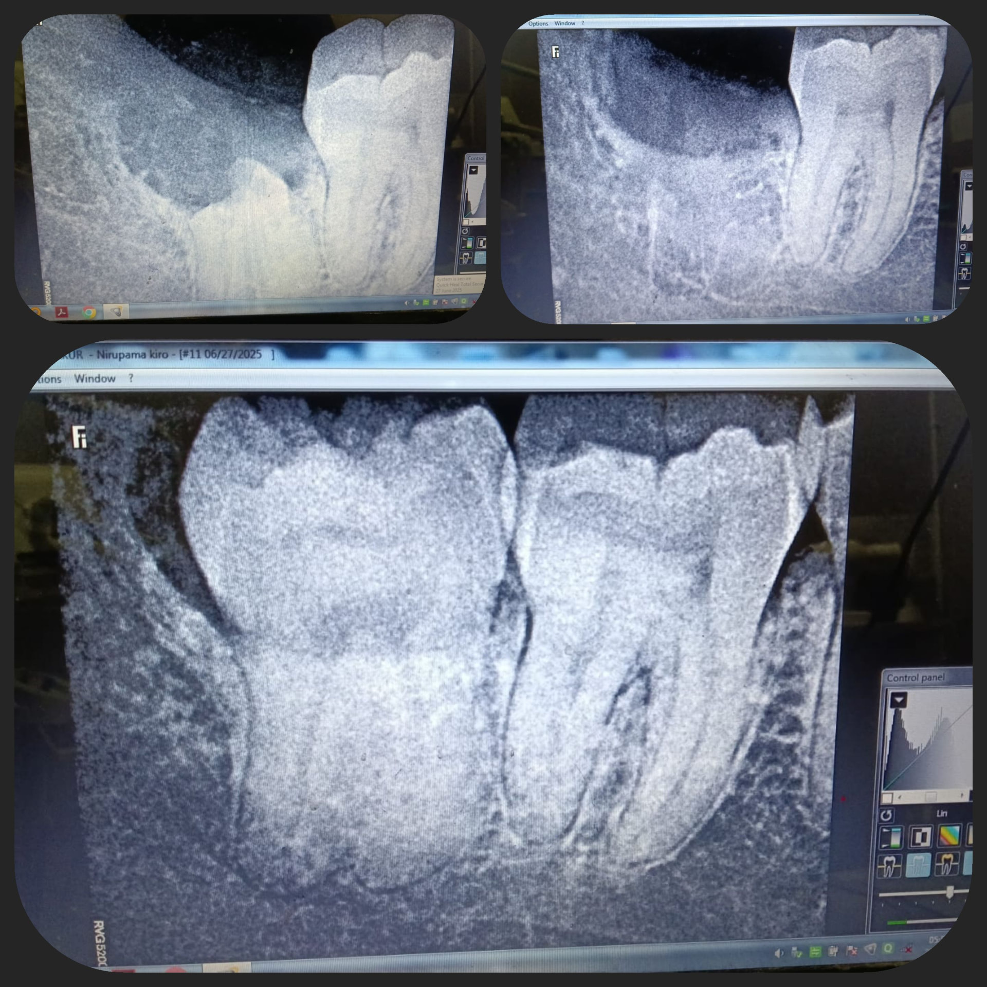 Impacted Tooth 5