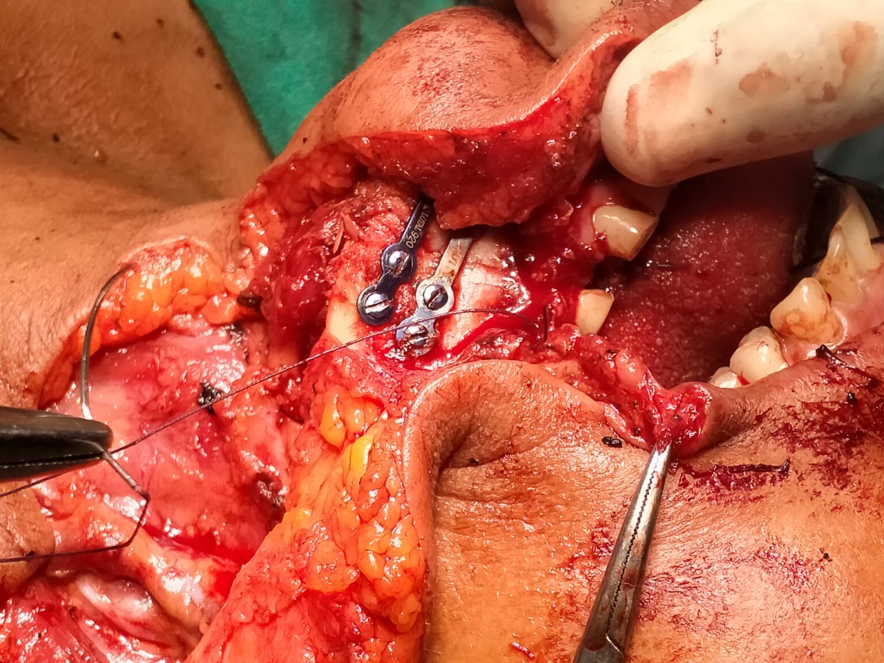 Surgical Case 5