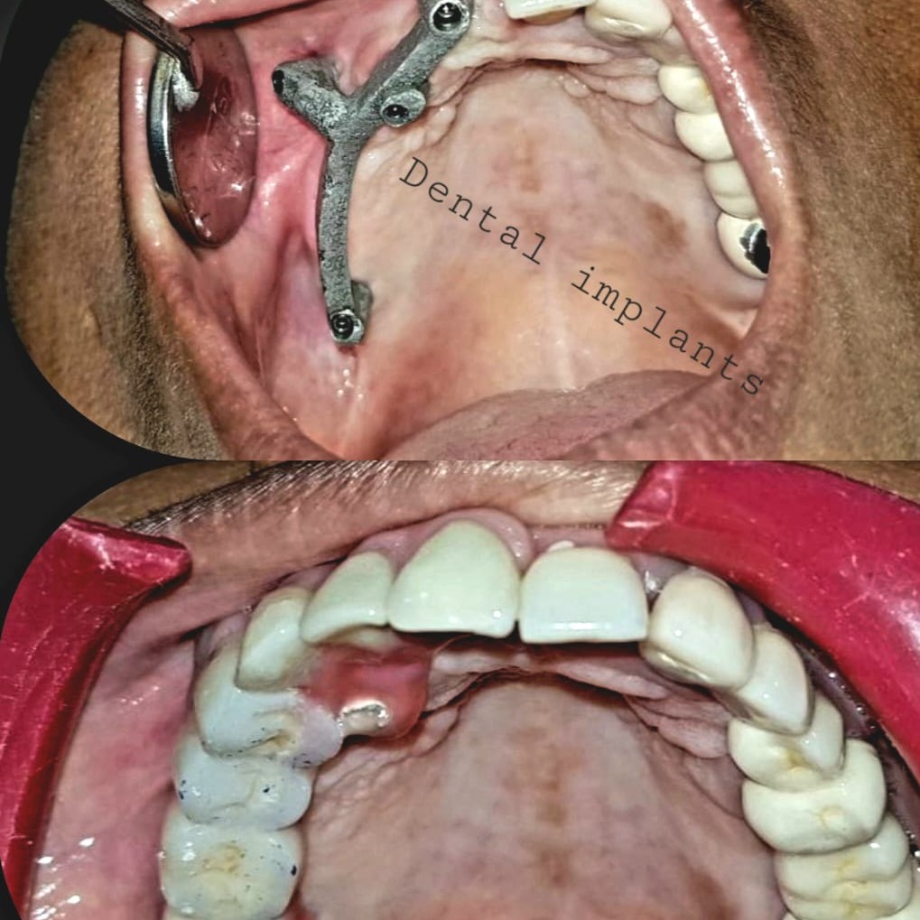 Dental Implants