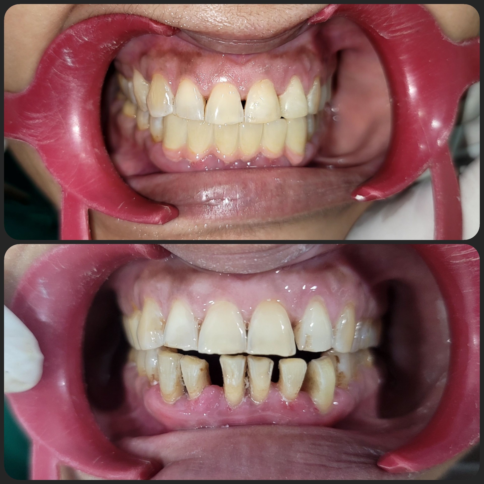 Gum Treatment