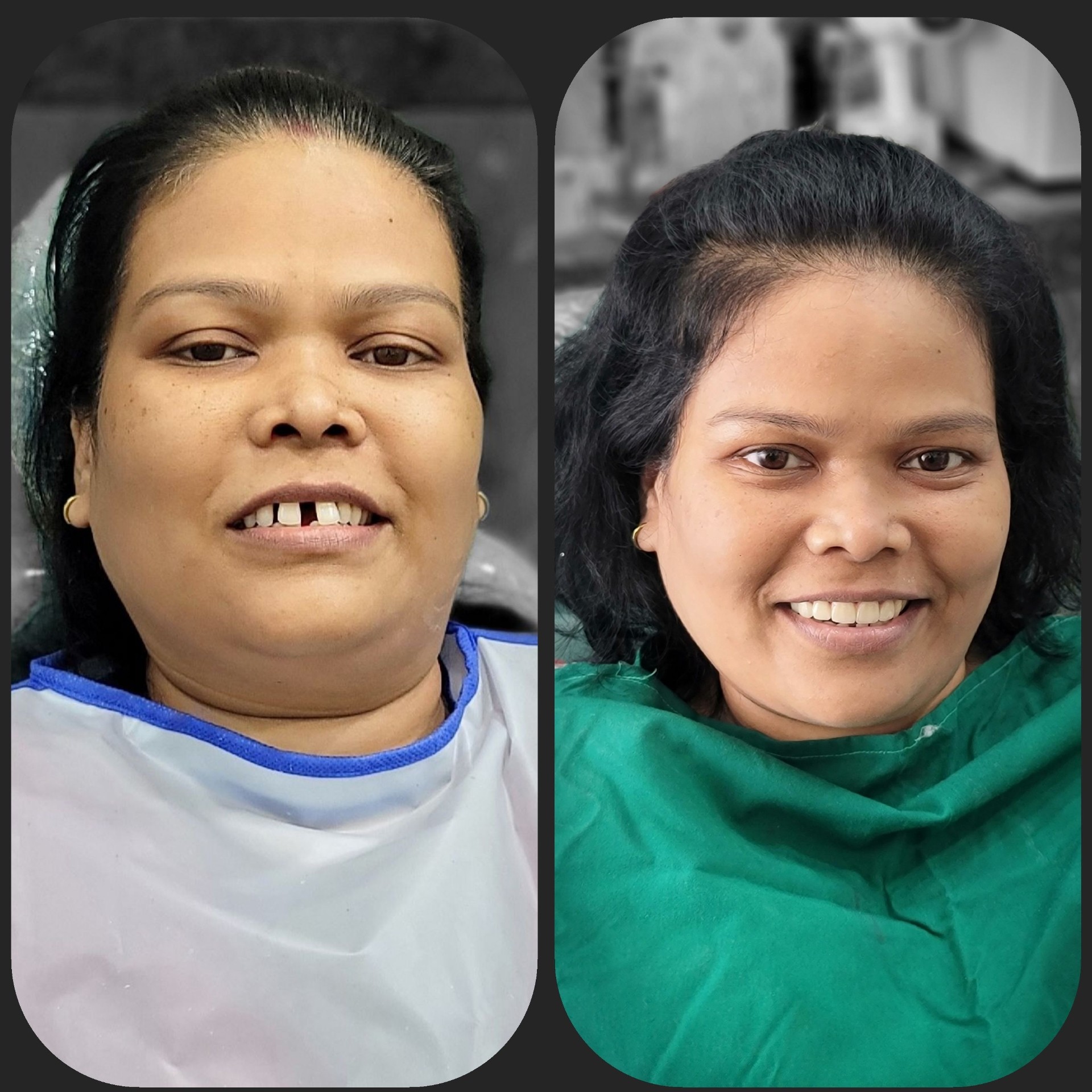 Smile Makeover