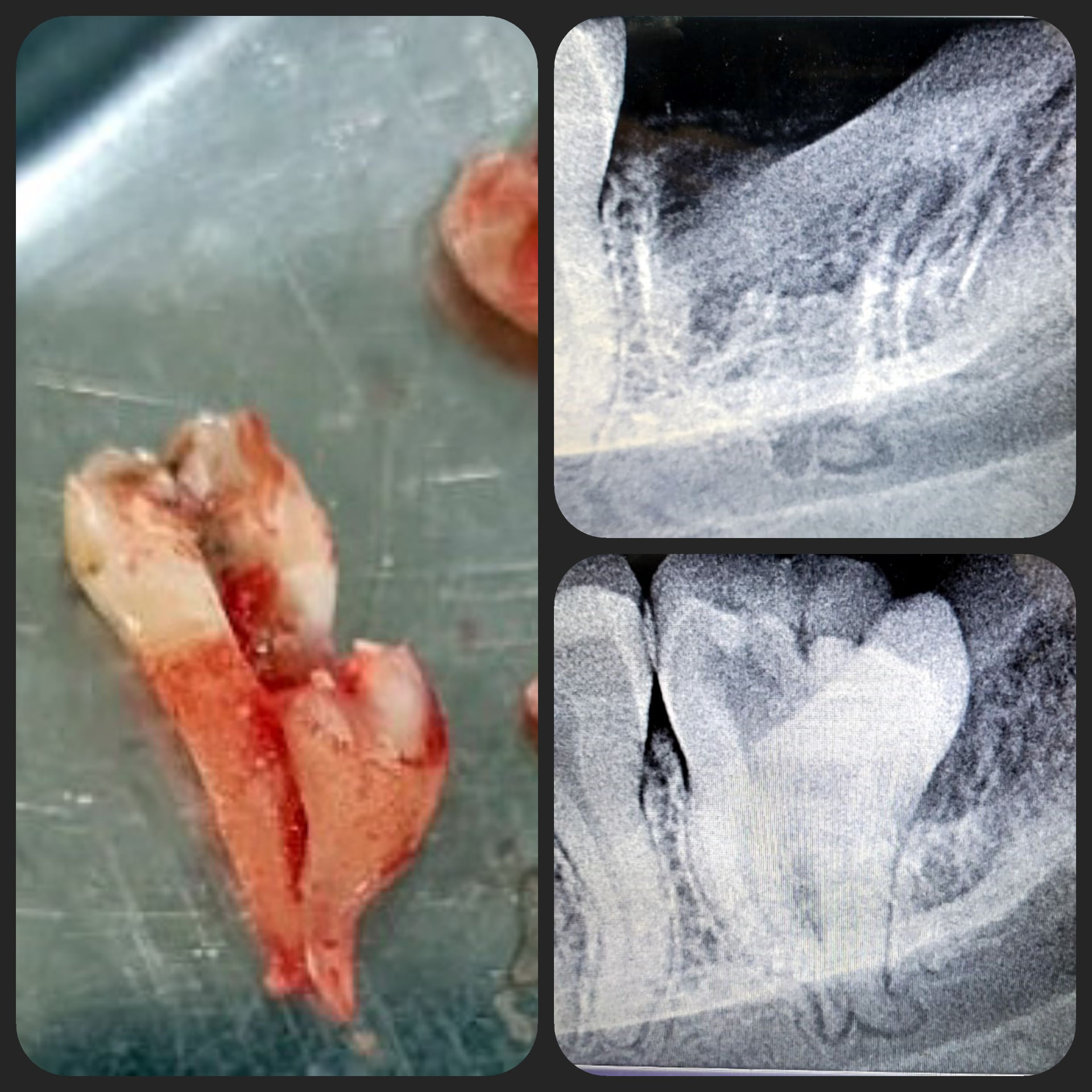 Impacted Tooth 6