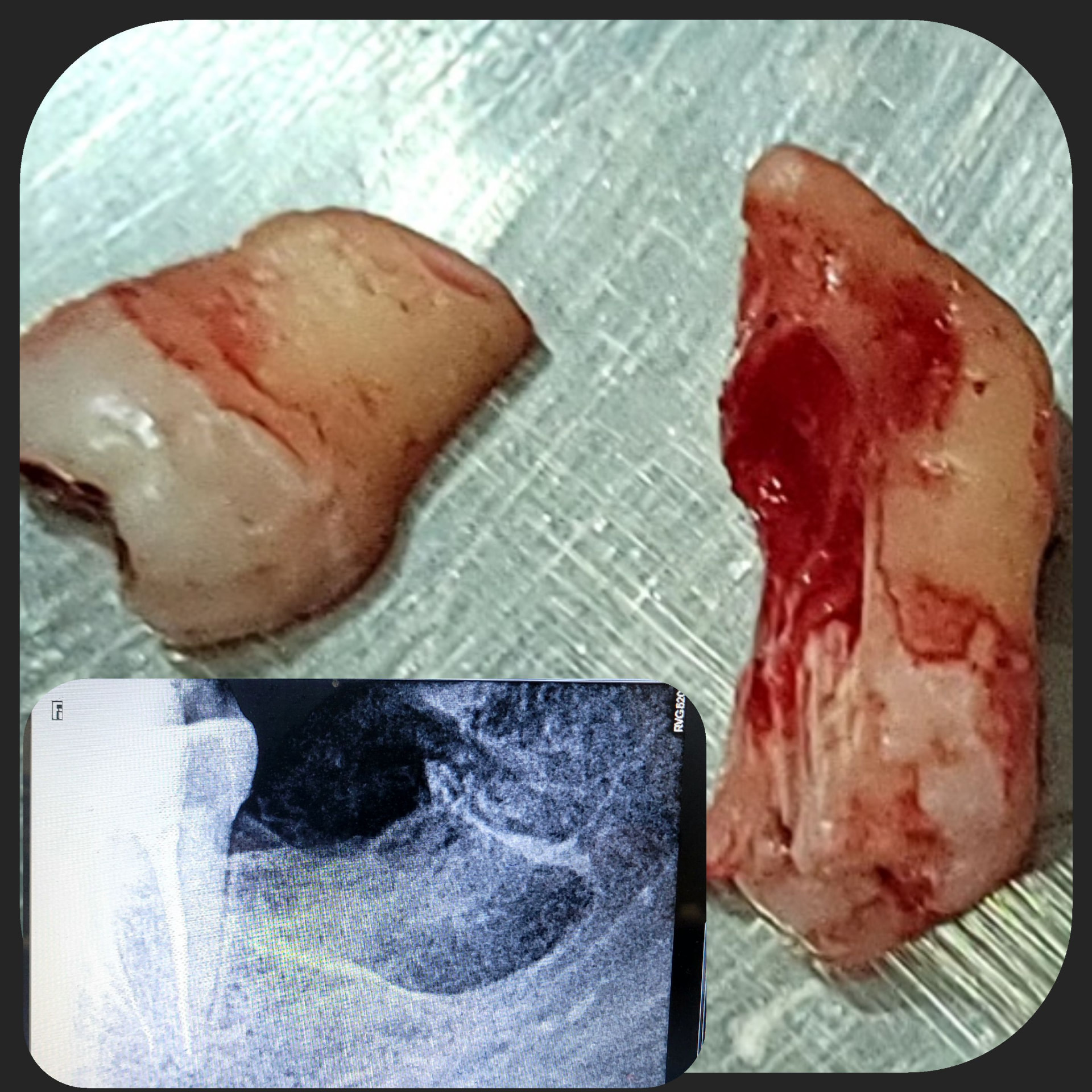 Impacted Tooth 3