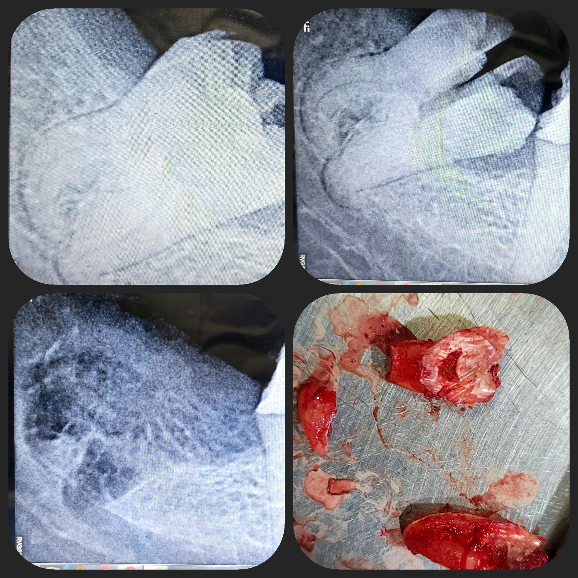 Impacted Tooth 2