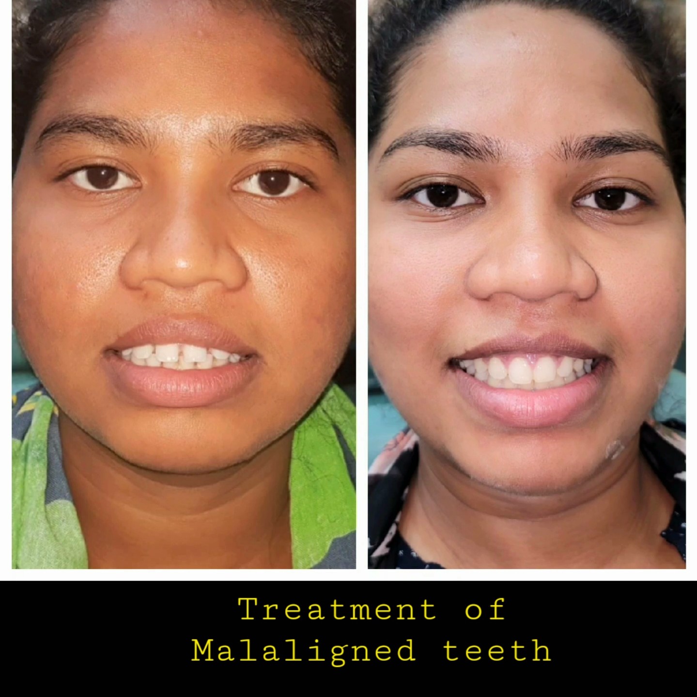 Orthodontics / Braces / Aligners