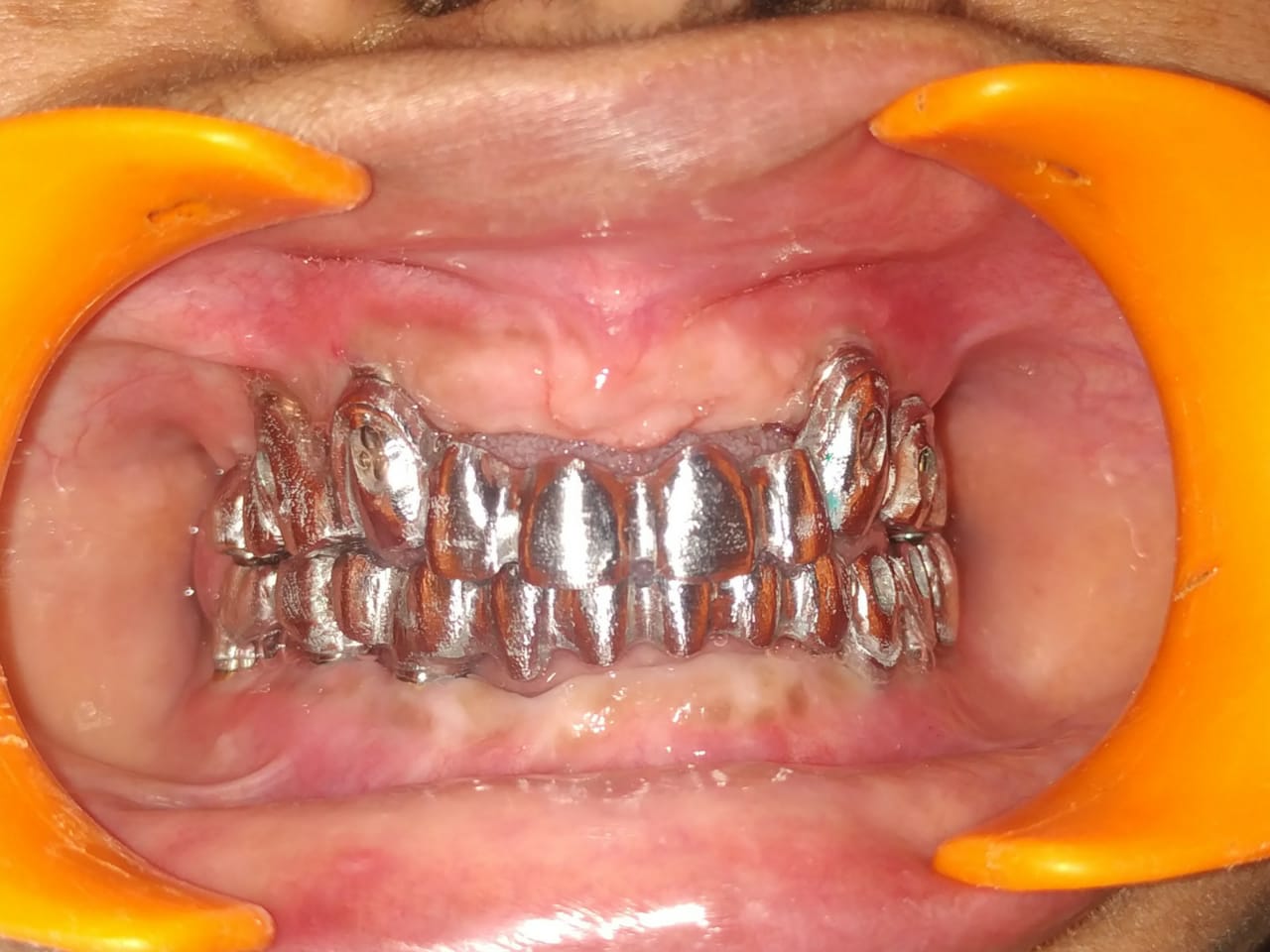 Full Mouth Rehabilitation
